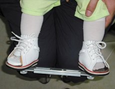 兒童足內(nèi)八字，外八字矯正