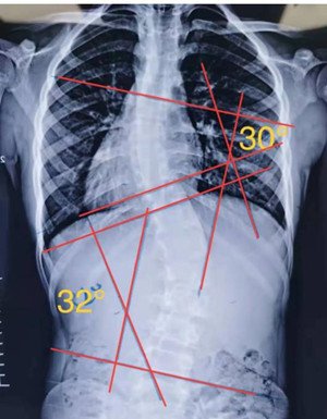 睡姿對(duì)脊柱側(cè)彎患者的影響