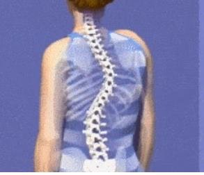 成人脊柱側(cè)彎怎么辦？