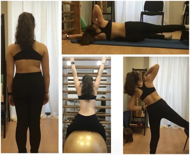 成人脊柱側(cè)彎怎么辦？